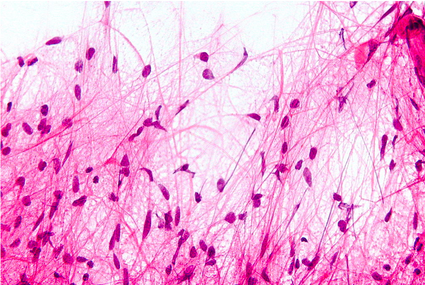 Microscopic features, with H&N staining, of pilocytic astrocytoma demonstrating ‘hair-like’ cell processes. 