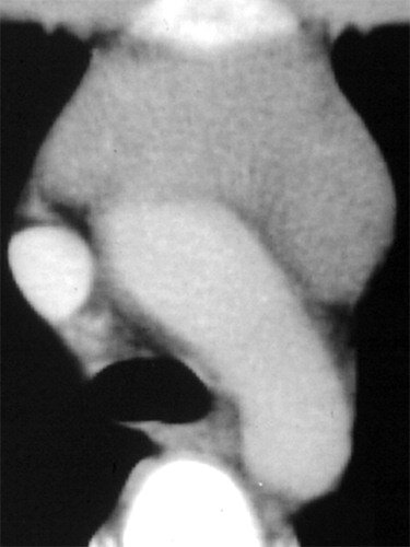 Contrast-enhanced CT scan shows a solid heart-shaped thymus