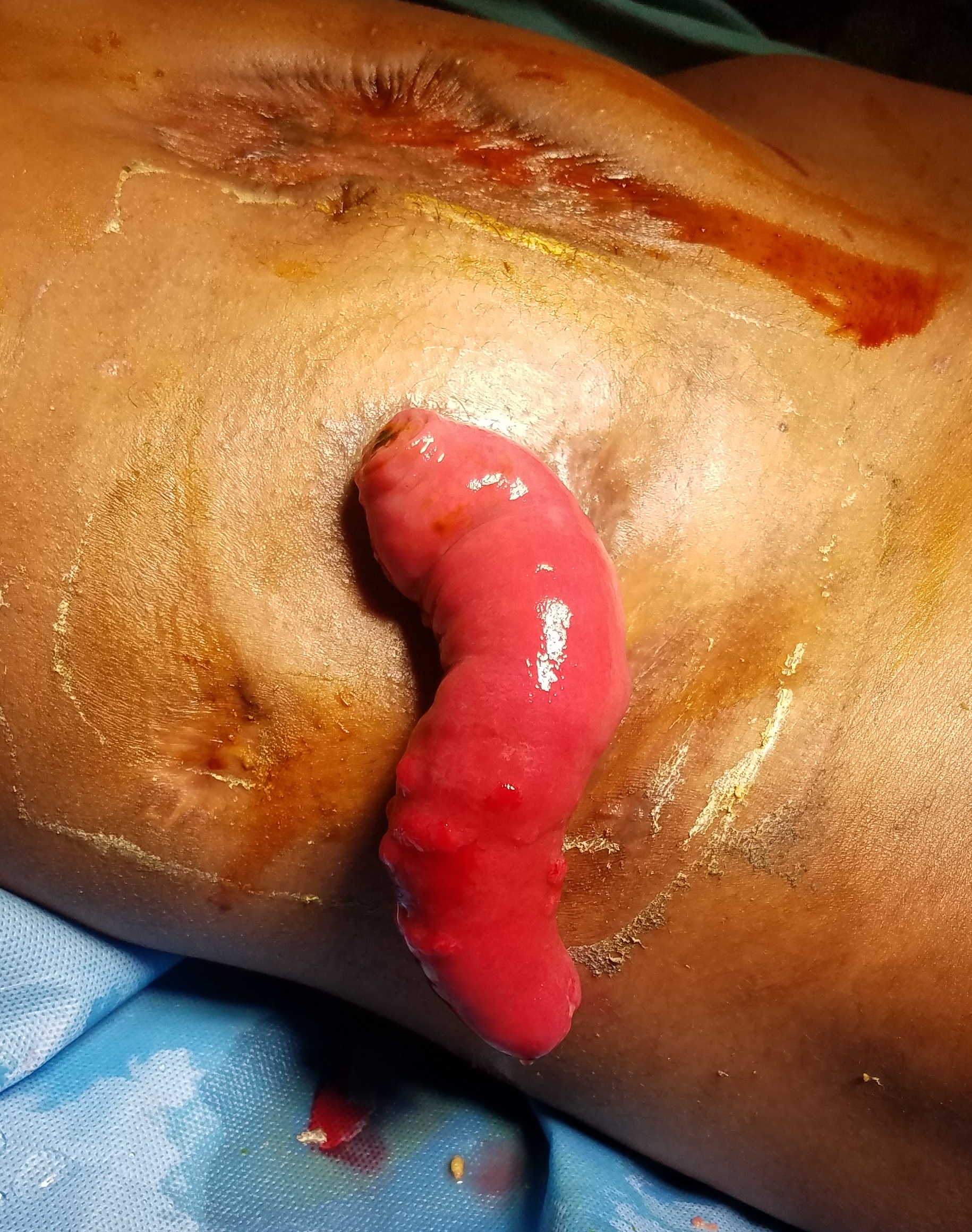 Colostomy prolapse of the distal limb of a stoma given for carcinoma rectum