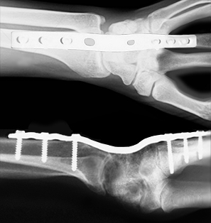 Wrist arthrodesis x ray