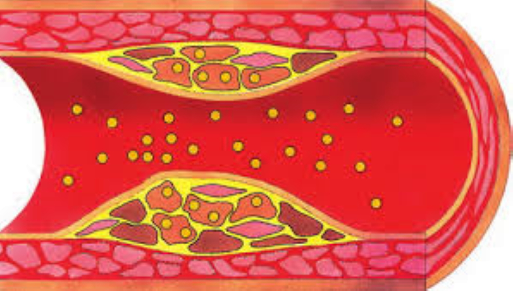 The figure shows the inside of an arterial vessel and the formation of atherosclerotic plaques due to the presence of hyperlipidemia.