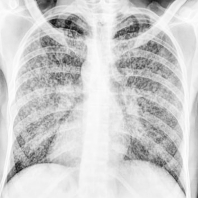 <p>Miliary Tuberculosis Radiography