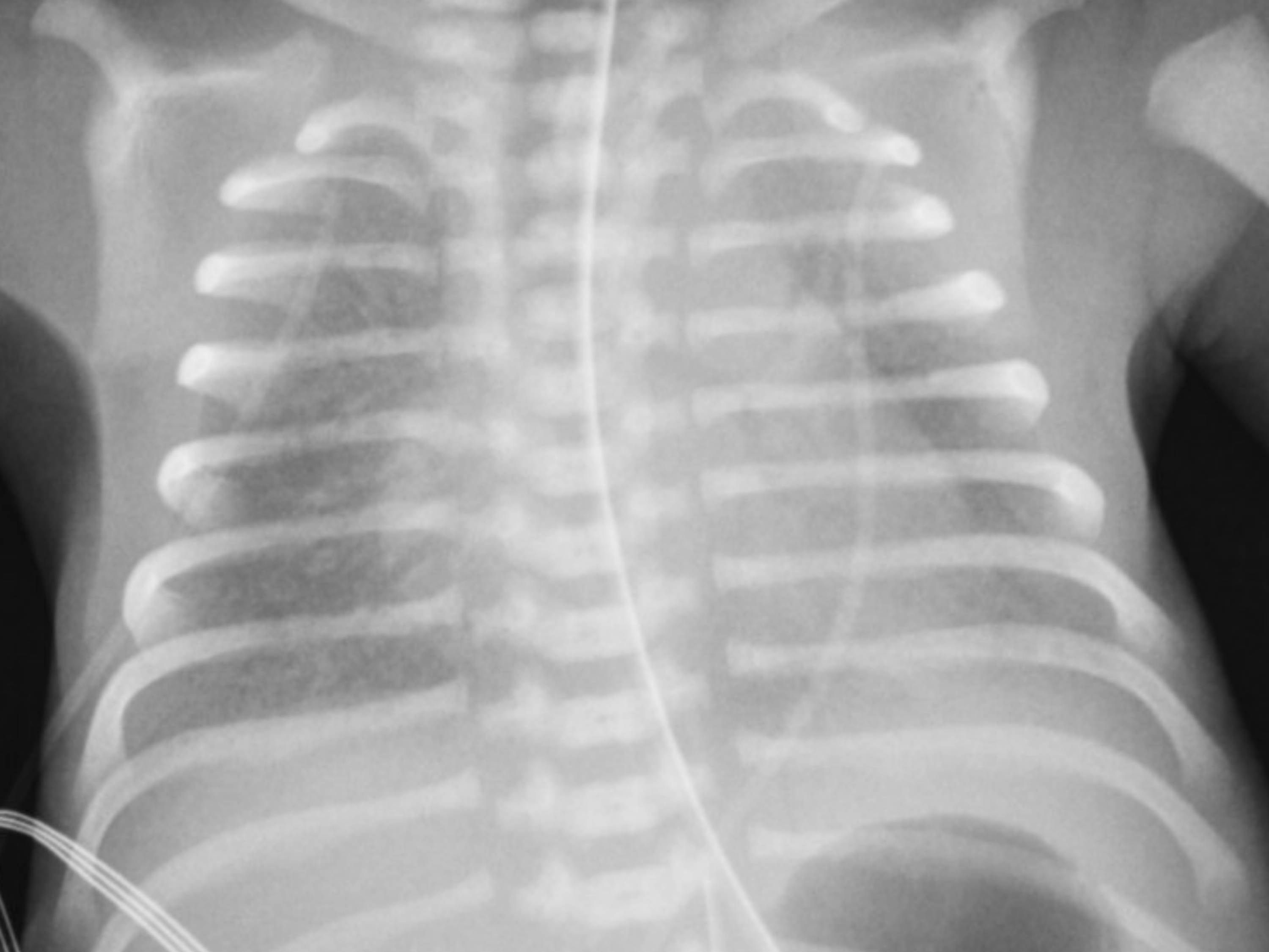 This is a chest radiograph of a preterm neonate with respiratory distress syndrome showing diffuse ground glass haziness bilaterally with air bronchograms. 