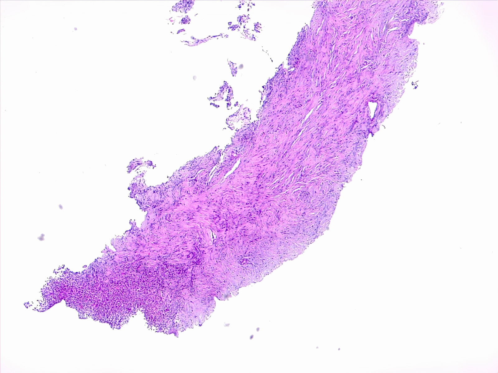 Lung pneumonia with fibrosis