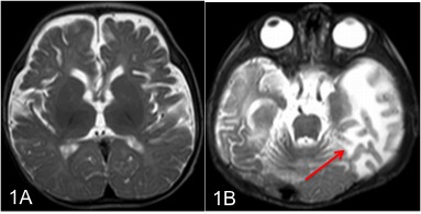 MRI Brain (T2W axial view) 
A