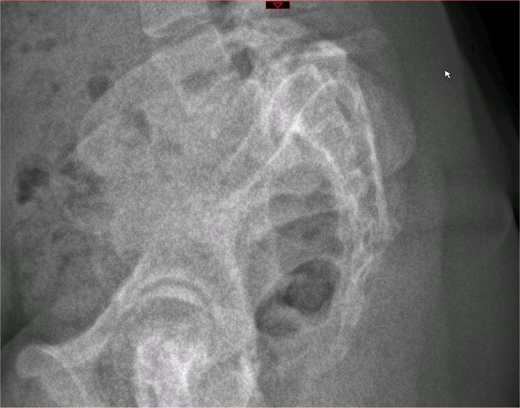 Lateral X-ray of the pelvis and lower lumbar spine showing spondylolysis and spondylolisthesis. 