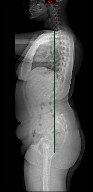 Whole spine X-ray showing C7 plumbline. A vertical line dropped from the C7 vertebra. Should fall just behind the heads of the femurs. This allows economic weight bearing.