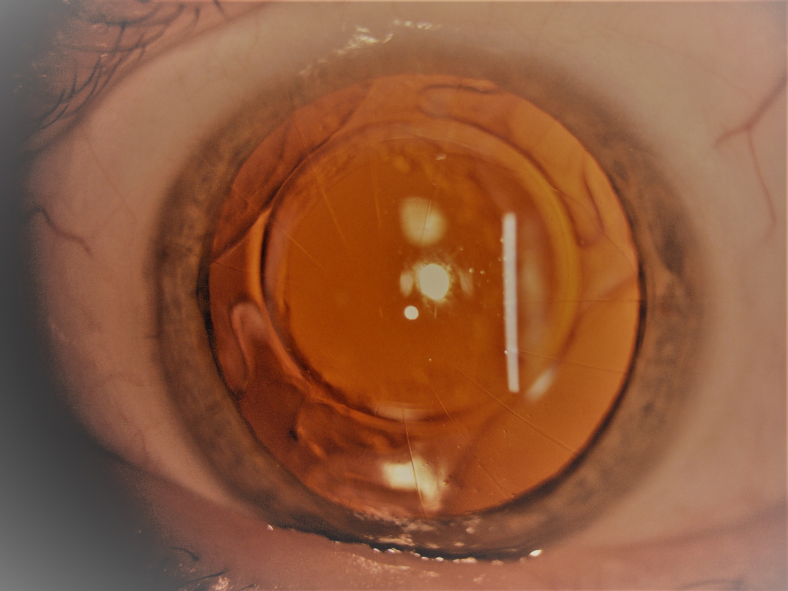 16-incision radial keratotomy in the left eye. The patient has had cataract surgery with implantation of an intraocular lens decades after the primary RK procedure.