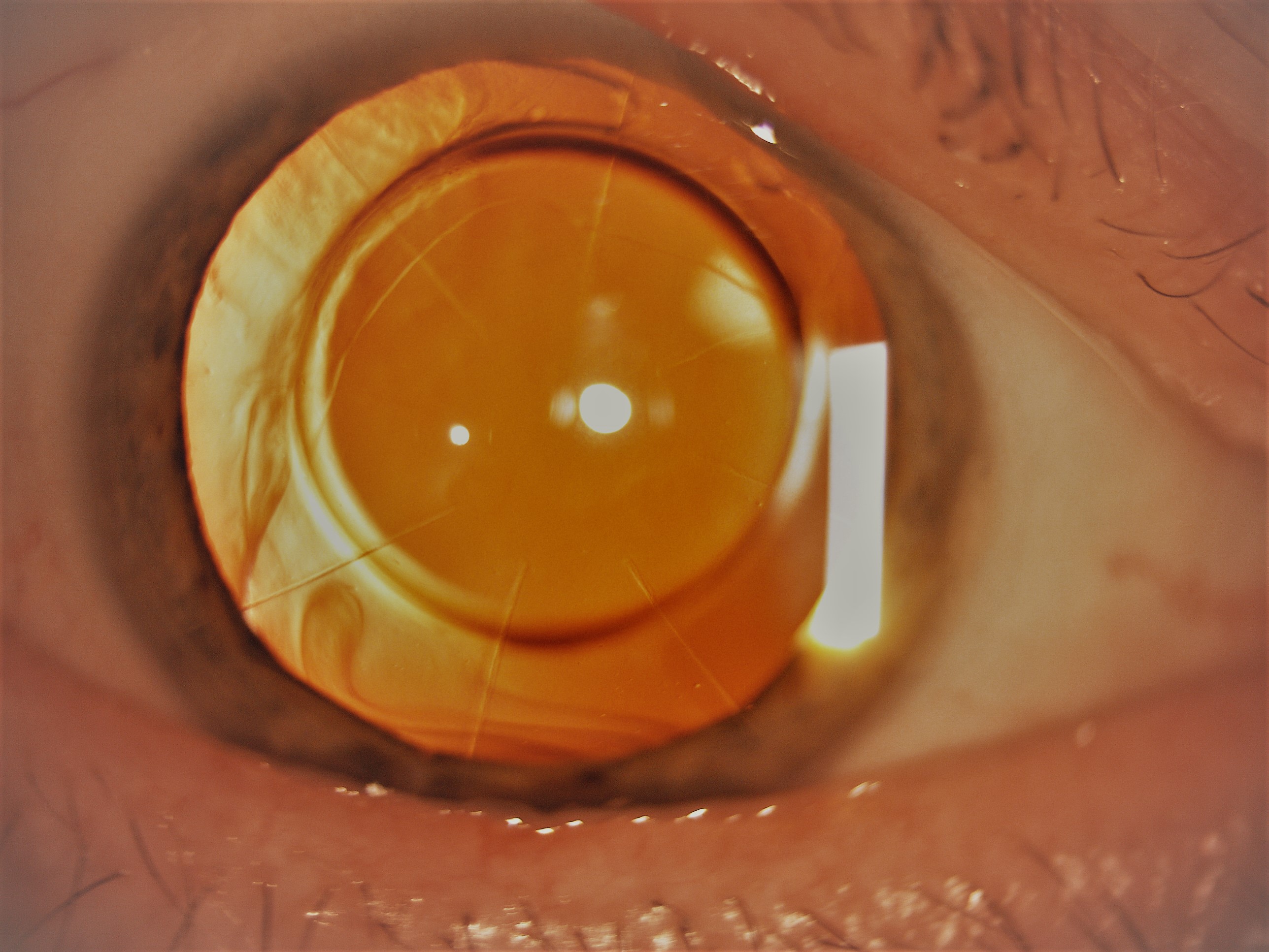 Standard 8-incision radial keratotomy with sparing of the pupillary zone. 