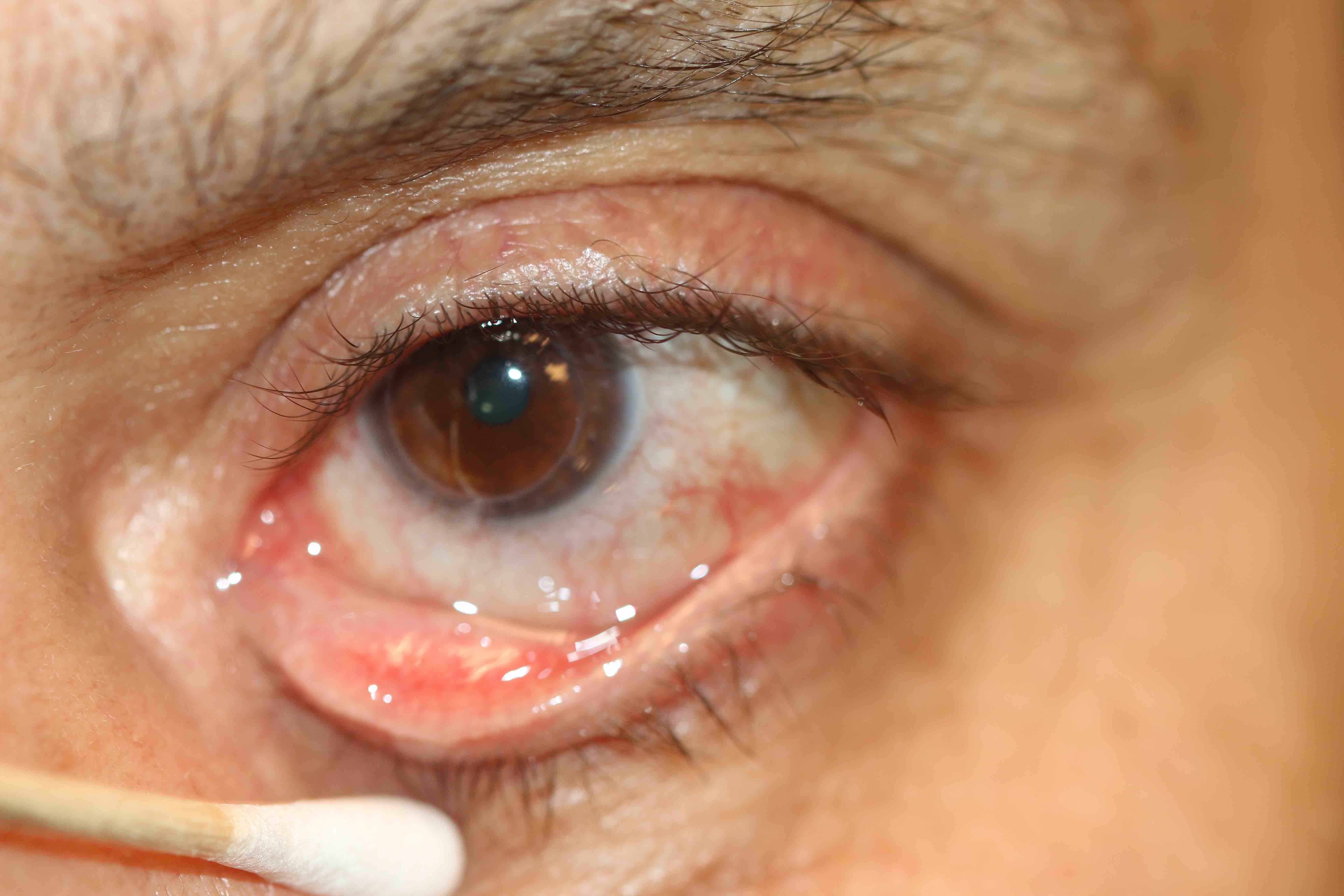 Punctal membrane caused by a chronic follicular conjunctivitis. Membranes may also develop in the presence of nasolacrimal duct obstruction or canaliculitis
