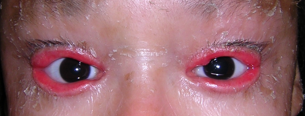 Complete obliterate of the lacrimal puncta secondary to chronic cicatricial ectropions caused by icthyosis