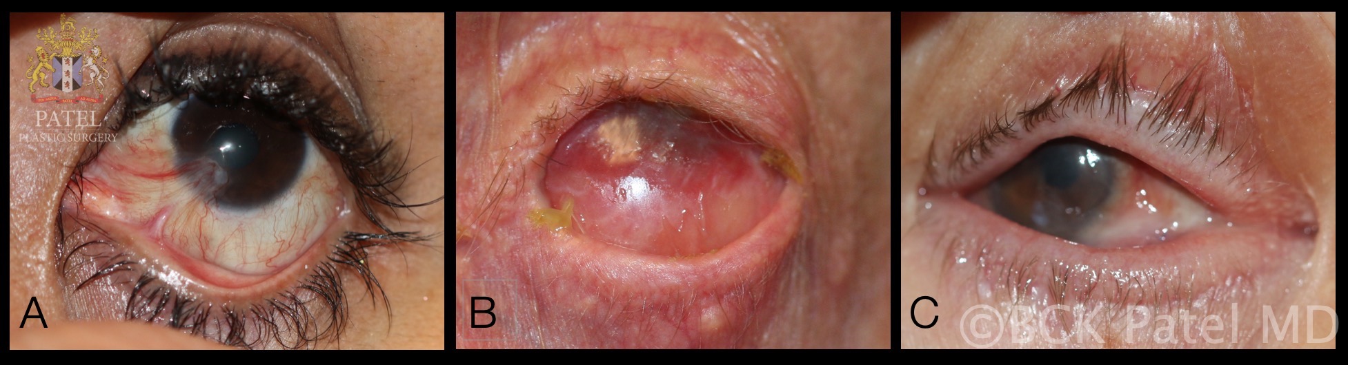 A. Punctal stenosis caused by a chemical burn with conjunctival and lid margin muco-cutaneous junction scarring
B. Complete obliteration of the puncta secondary to cicatrization caused by Stevens Johnson syndrome
C. Punctal occlusion in the presence of mucous membrane pemphigoid disease
