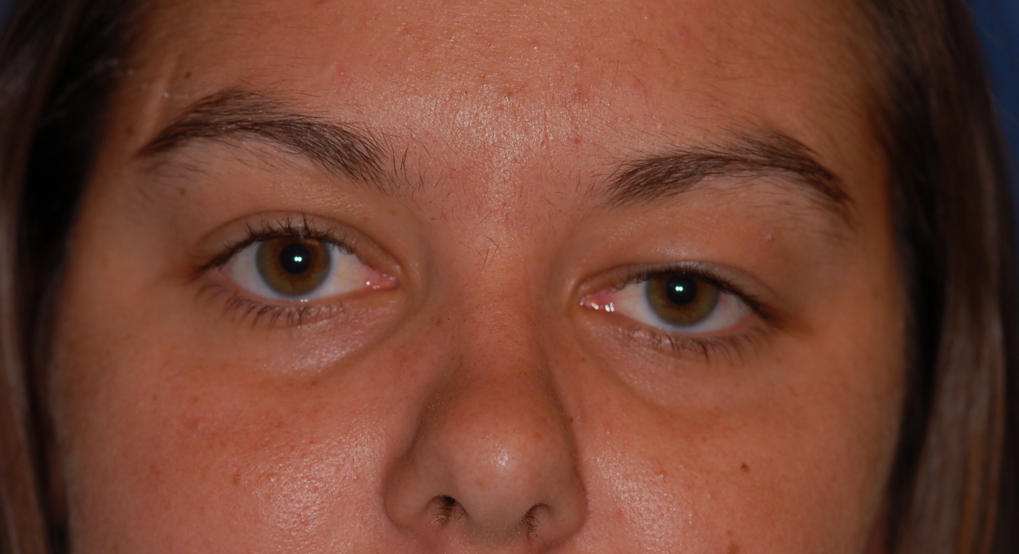 Blepharochalasis: A 36-year-old female with her fifth episode of left-sided upper eyelid swelling. There is no pain or tenderness, no double vision and no limitation of ocular movements. The swelling settled in four days without any active treatment
