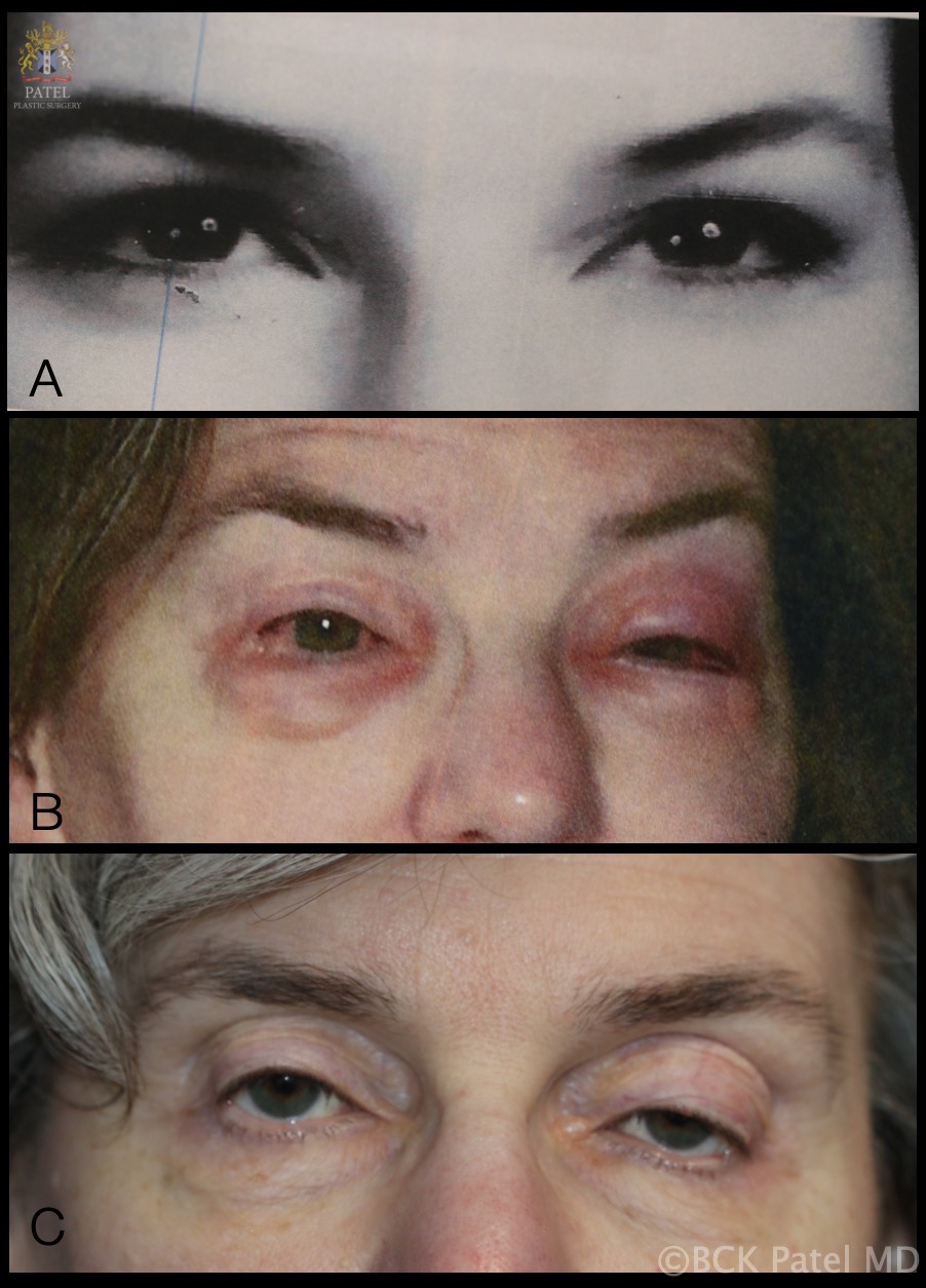 Blepharochalasis: A. Photograph that patient brought which was taken at the age of 18 years.
B. One of multiple episodes of bilateral periorbital swelling which lasted "a few days each time".
C. Appearance at age 54 years after having had attacks of blepharochalasis lasting a few days each time over several years. Patient now has periorbital tissue atrophy with levator disinsertion ptosis, loss of upper eyelid and brow fat and thinning of the eyelid skin
