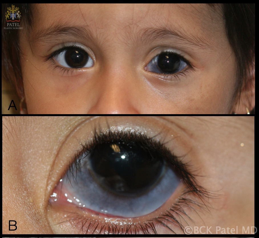Nevus of Ota in a 3-year-old female: pigmentation of the eyelid skin and sclera