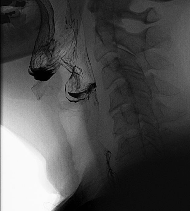 Single lateral image of the hypopharynx demonstrates phonation evaluation.