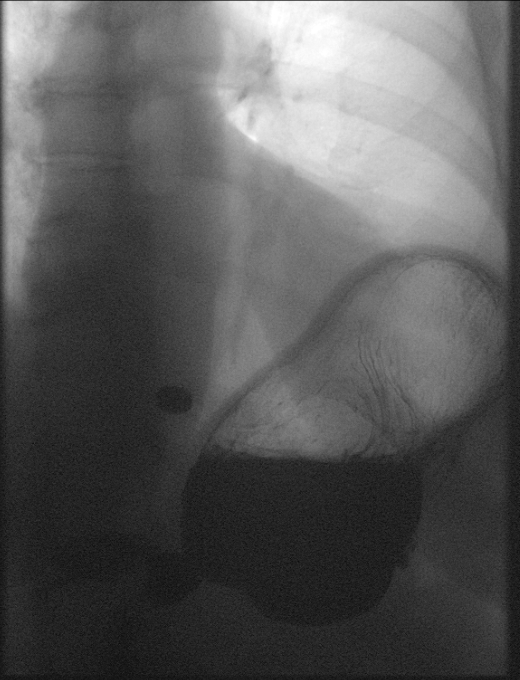 Single frontal fluoroscopic image at the level of the lower esophagus and stomach demonstrating a pill immediately proximal to the gastroesophageal junction.