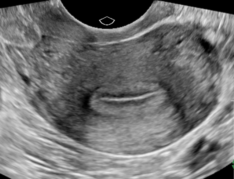 Transverse/coronal view of the uterus.