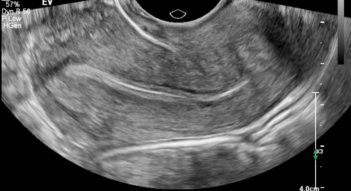 Transvaginal longitudinal view of the uterus