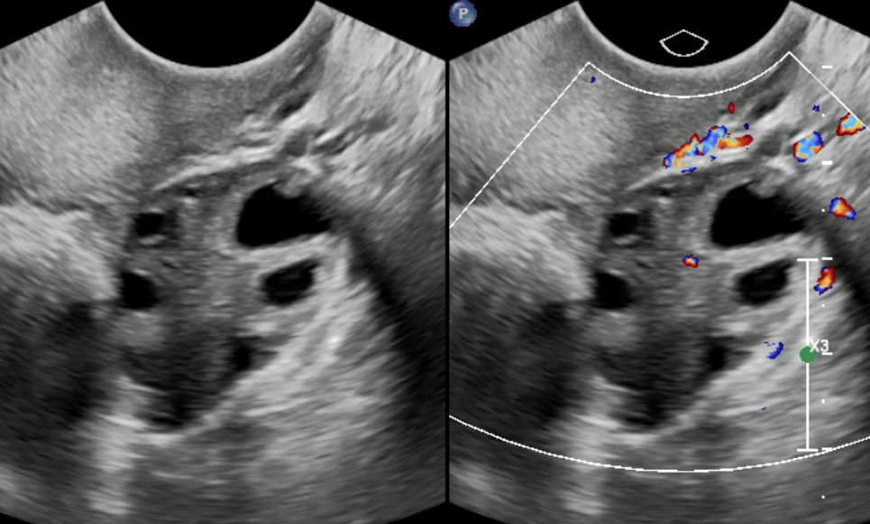 Sonographic image of the right ovary with and without doppler evaluation.
