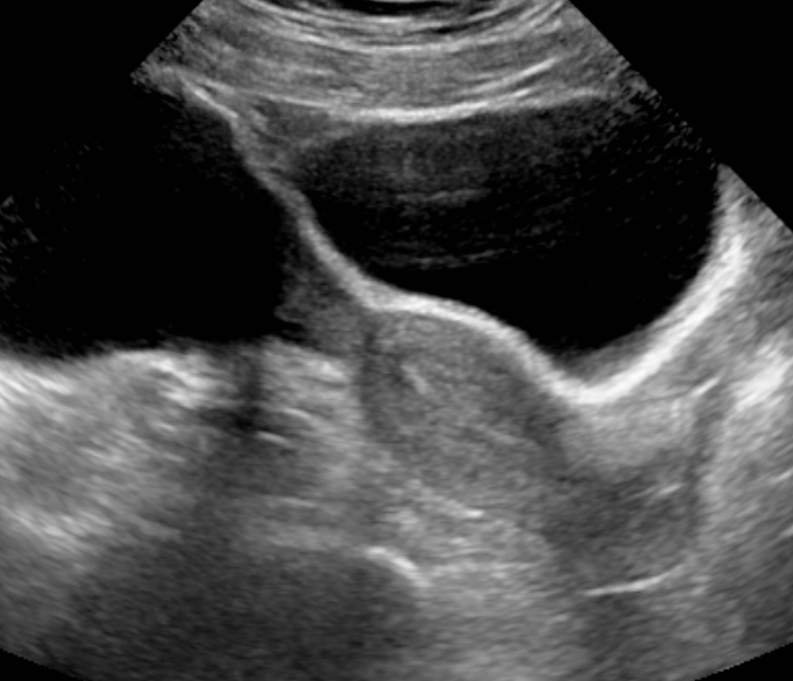 Transabdominal longitudinal view of the uterus.