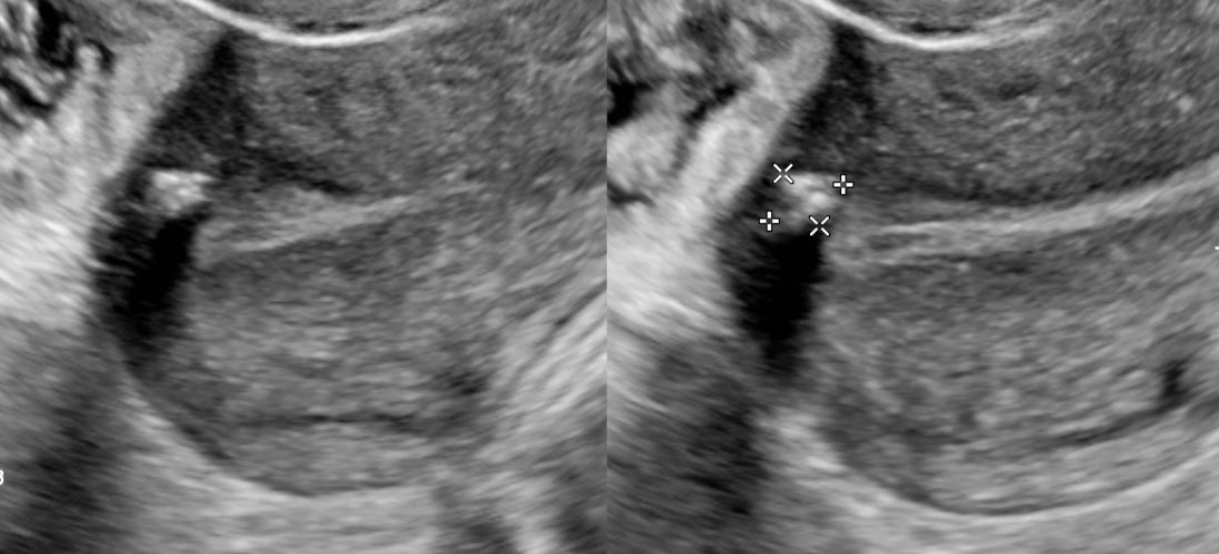 Single sonographic image demonstrates a calcified fibroid.