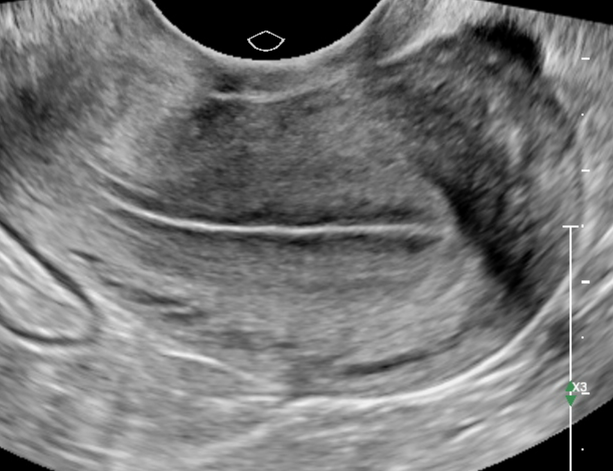 Single sonographic evaluation of the uterus demonstrates a retroverted uterus.