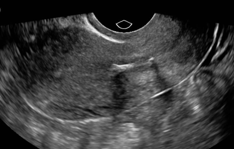 Single sonographic evaluation of the uterus demonstrates a malpositioned intrauterine device.