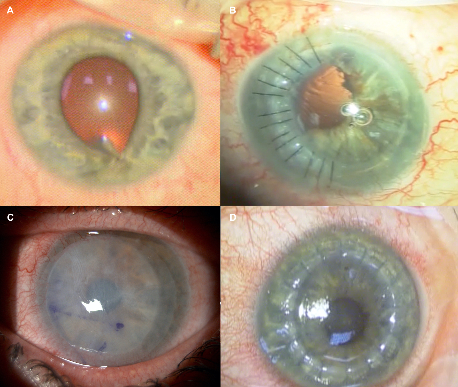 From top right clockwise: A shows penetrating corneal injury with iris distortion inferiorly; B corneal laceration repair; C amniotic membrane in a contact lens delivery system (Omnigen) to aid re-epithelisation after chemical injury; D corneal transplantation required for scarring affecting the visual axis.