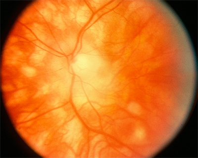 Birdshot retinopathy