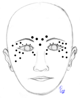 Botulinum toxin injections for blepharospasm may be administered at some or all of the sites shown. The dose will vary from point-to-point, depending upon the severity of the blepharospasm and apraxia of eyelid opening. The pretarsal injections are administered to counter the apraxia of eyelid opening. The injections just lateral to the lateral nasal wall are to reduce the squeezing of the nasalis muscle which is seen in some patients. Injections into the corrugator and procerus muscles reduce the downward movement of the brow and therefore the eyelids. Injections just below the brows will allow a chemical lift to the brows, thereby improving the ability to open the eyelids. One must be careful to injected a minimal amount over the zygomaticus major and minor muscles so as to avoid the appearance of a lower facial weakness after injections. 