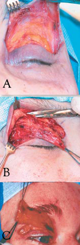Limited Myectomy for Blepharospasm: A. The upper eyelid orbital and preseptal orbicularis muscle is dissected from the skin via an eyelid creas incision. The pretarsal muscle is removed as well but to a degree that is determined by the extent of apraxia of eyelid opening present. B. Care is taken to protect the skin with a meticulous dissection. C. Removal of the orbicularis muscle en bloc