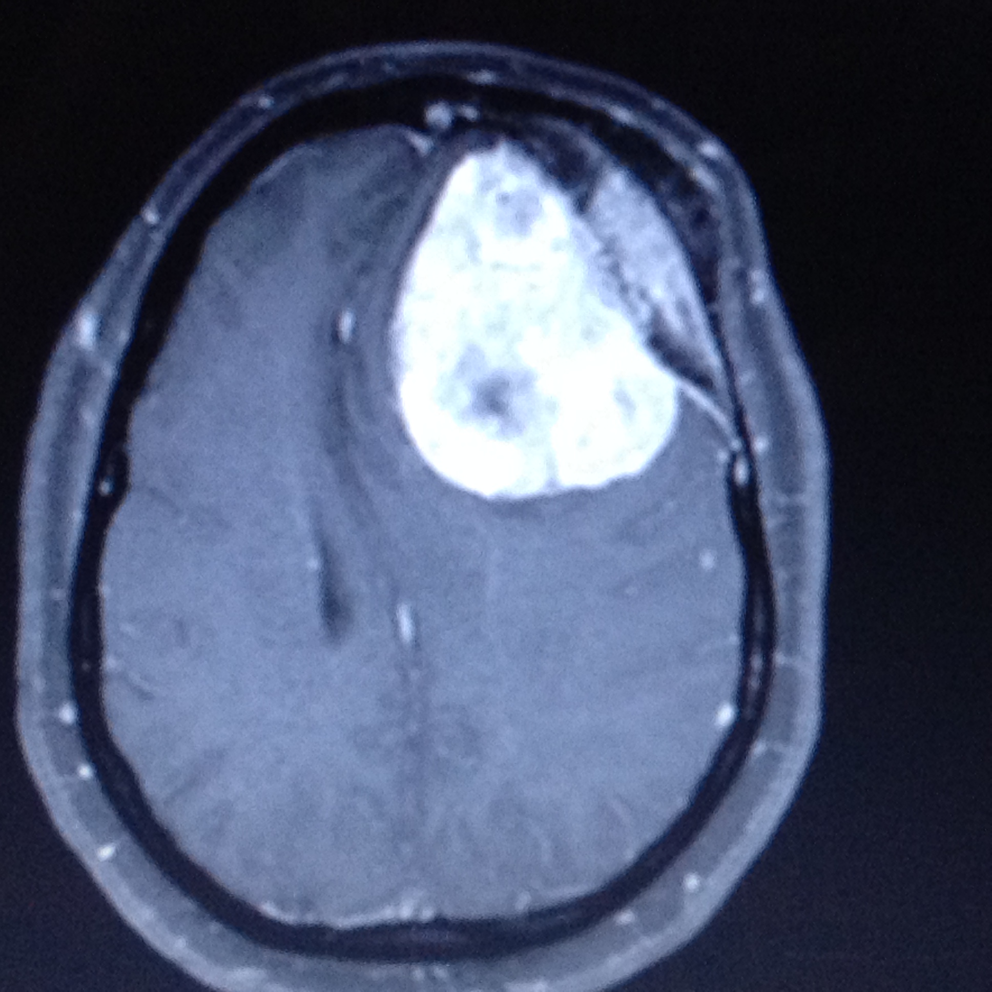 Frontal meningioma with hyperostosis