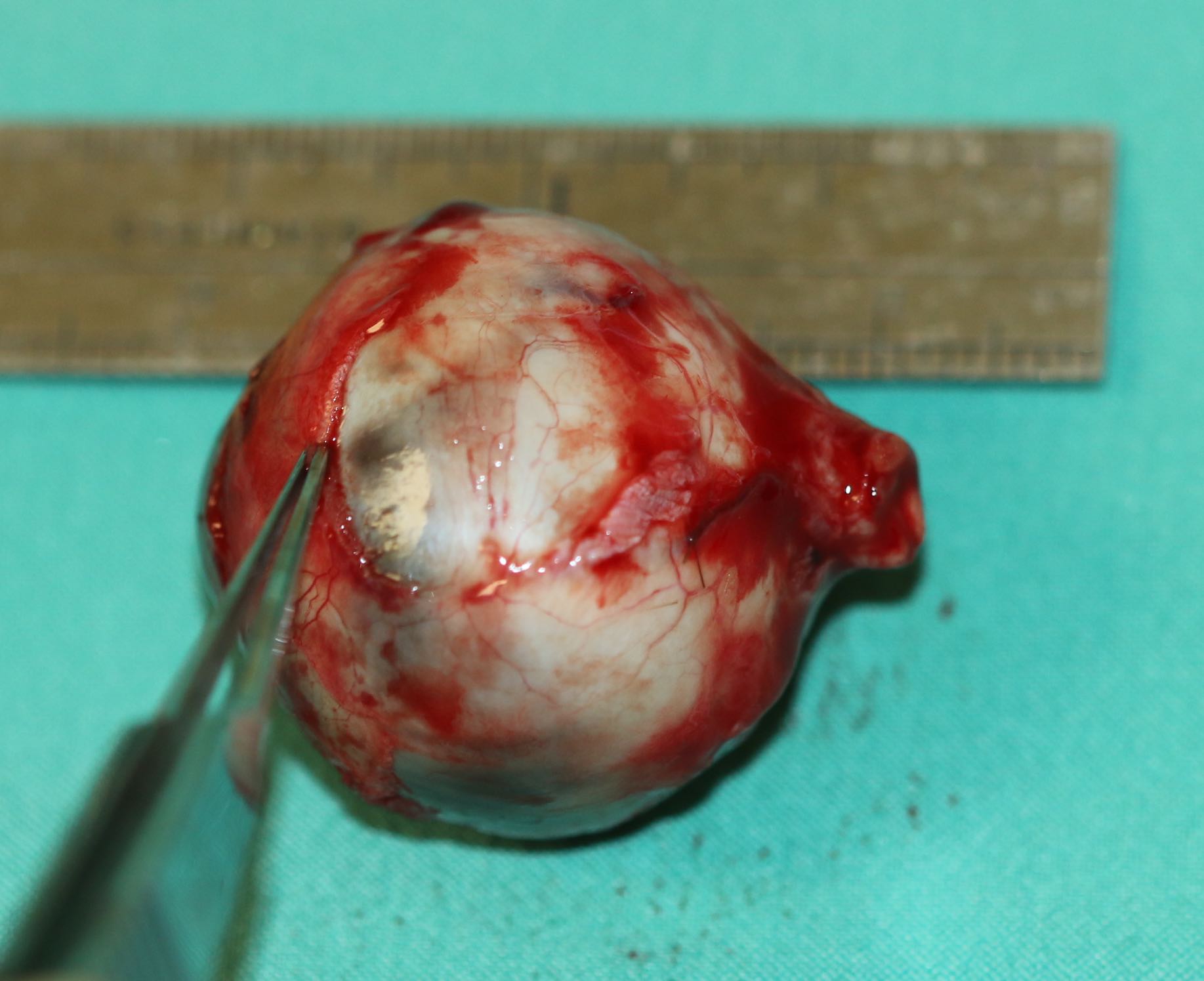 Enucleation. A globe full of tumor may make it difficult to obtain an adequate length of optic nerve during enucleation as seen here