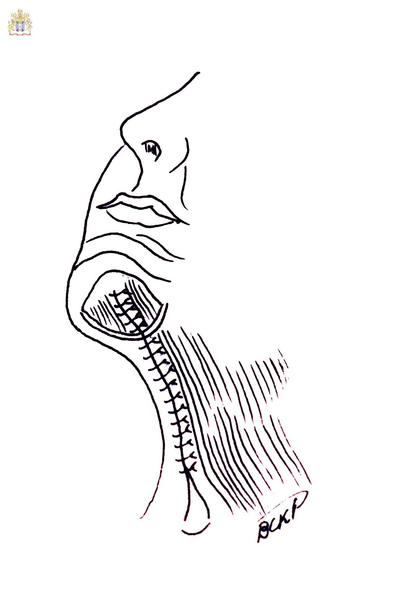 The Corset Platysmaplasty where the medial separated platysmal bands are sutured with two or three layers of sutures from the mentum to the supraclavicular zone. Some surgeons now feel that this may bring the platysma down and result in recurrence of bands in the neck and that a better way to manage the platysma is to tighten and lift it laterally and mostly superiorly with or without platysma myotomies. 