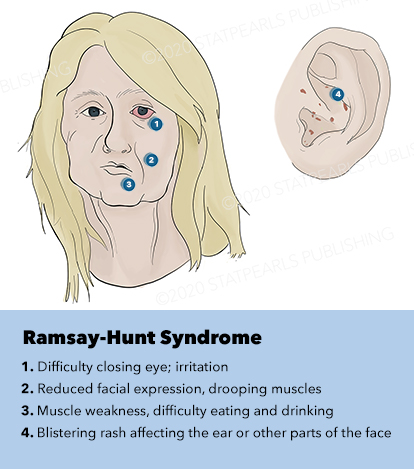 Ramsay-Hunt Syndrome