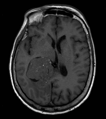 Intraventricular meningioma (atrium) MRI T1