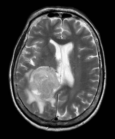 Intraventricular meningioma (atrium) MRI T2