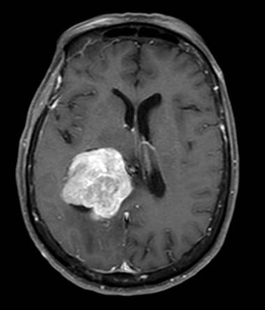 Intraventricular meningioma (atrium) MRI with contrast