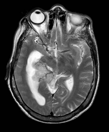 Intraventricular meningioma (atrium) MRI T2 showing the anterior and posterior choroidal arteries feeders