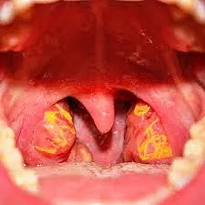 In Tangier's disease, the tonsils (as in the photo) appear enlarged and with a typical yellow-orange color.