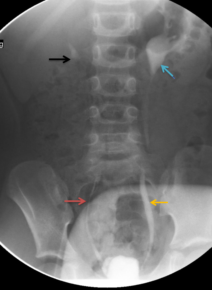 Fluoroscopic spot image of voiding cystourethrogram (VCU) showing bilateral vesicoureteral reflux (VUR).
Grade II VUR on right side with contrast refluxed into the non dilated ureter (red arrow) and pyelocalyceal system (black arrow) without dilatation.
Grade III VUR on left side with contrast refluxed into mildly dilated ureter (yellow arrow) and mildly dilated left renal pelvis ( blue arrow).
