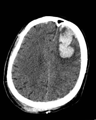 Large left frontal cerebral contusion after occipital  trauma