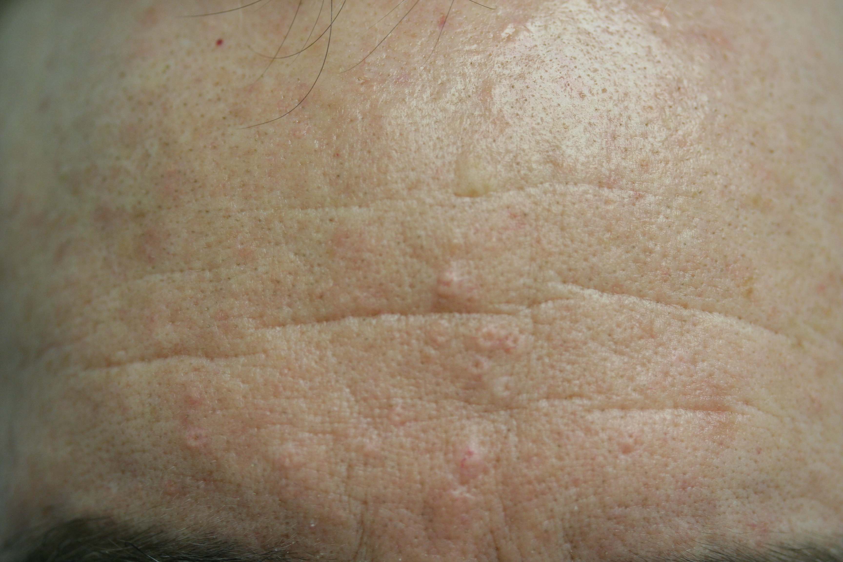 Multiple sebaceous hyperplasias on forehead.  These regressed with oral isotretinoin treatment.