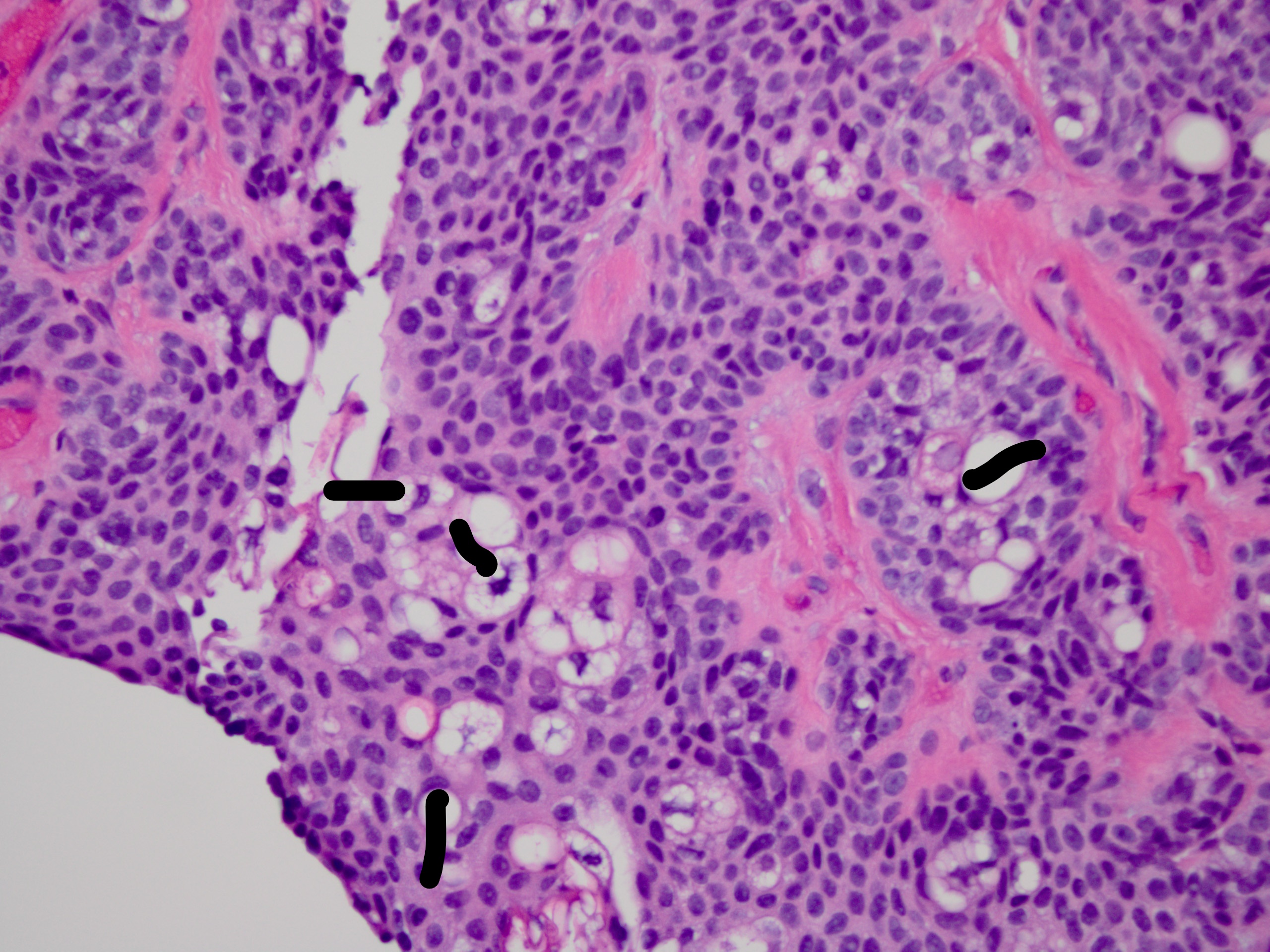 Sebocytes have a soap bubble appearance. Their nuclei are scalloped or indented (black marks).