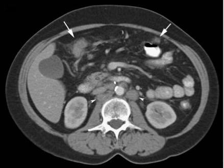 PMID 22347961 CT scan image showing infiltration and nodularity of peritoneum with formation of 'omental cakes' and lymphadenopathy.