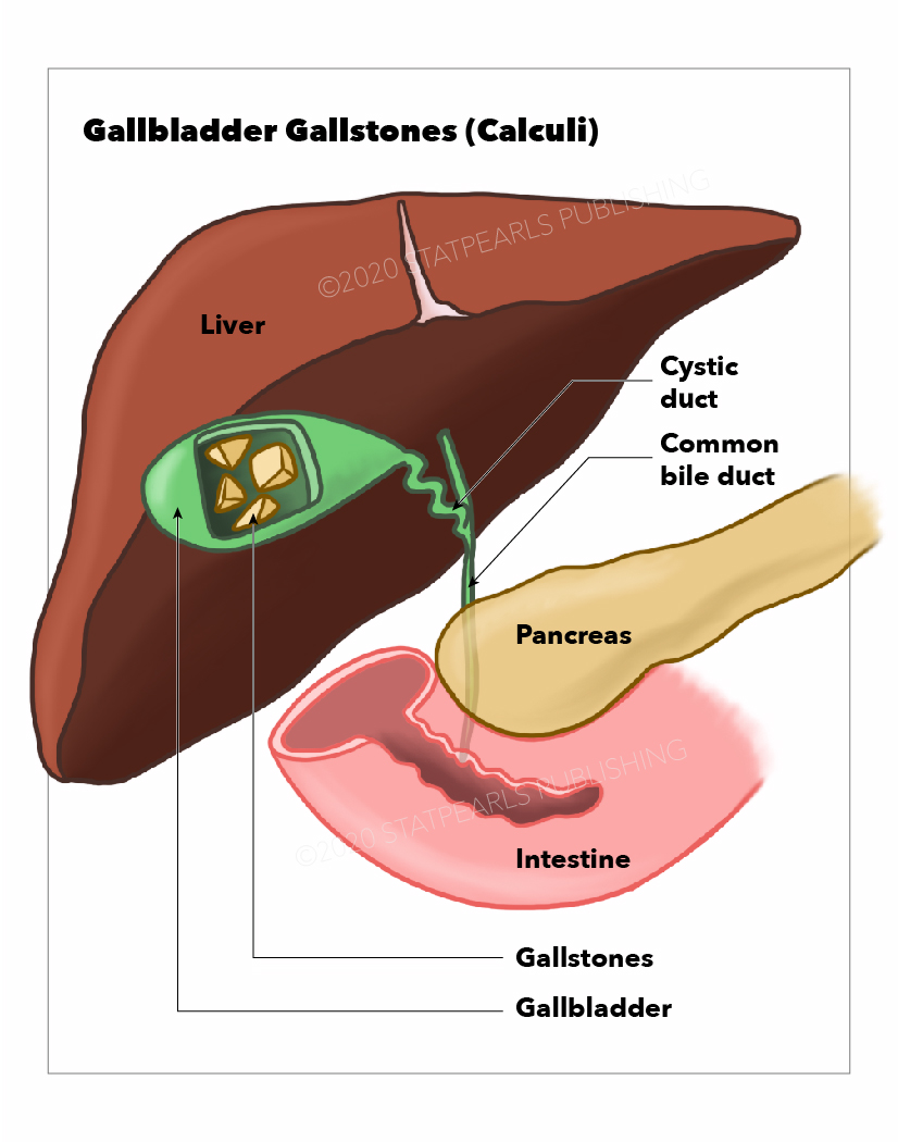Gallbladder Gallstones (Calculi), Common 
bile duct, Pancreas, Intestine, Gallbladder, Gallstones, Liver