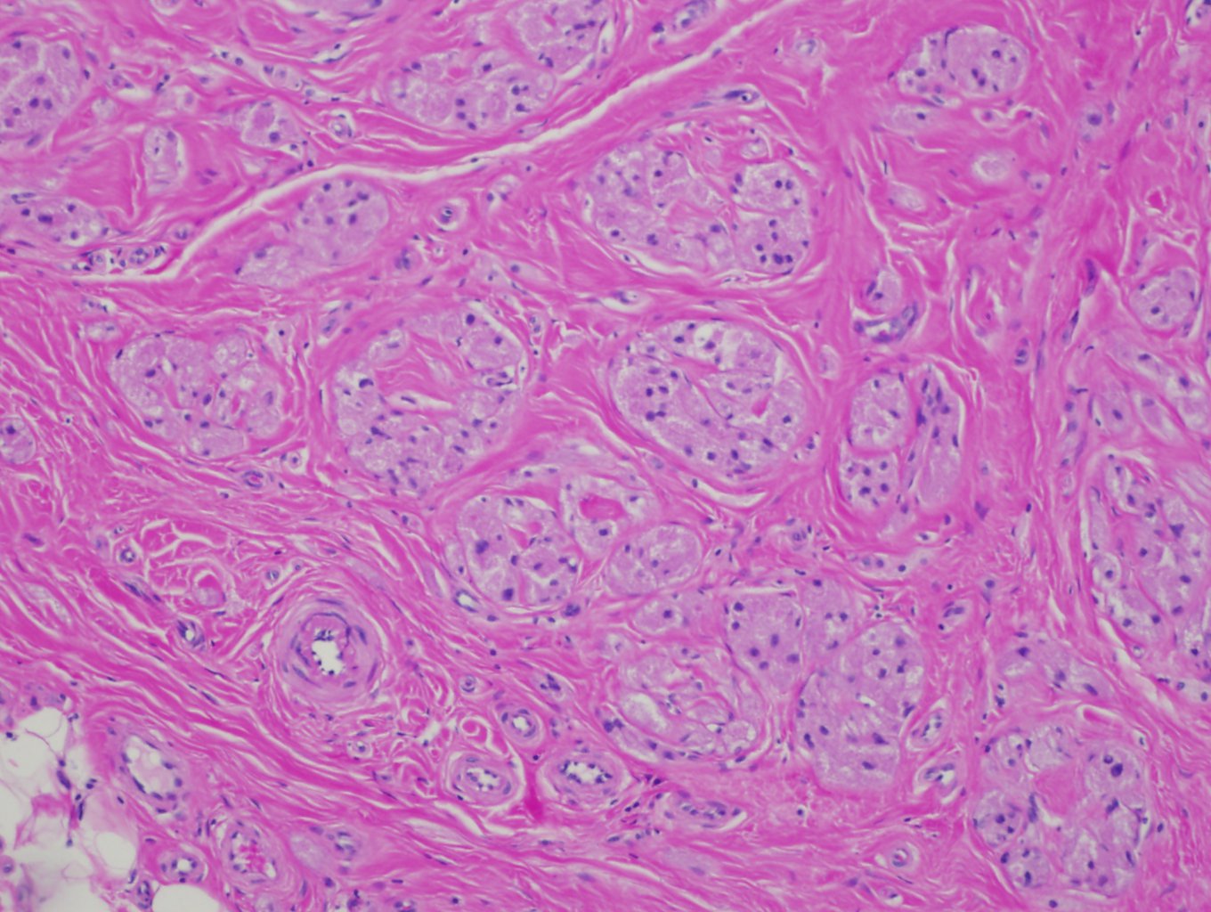 Granular Cell Tumor