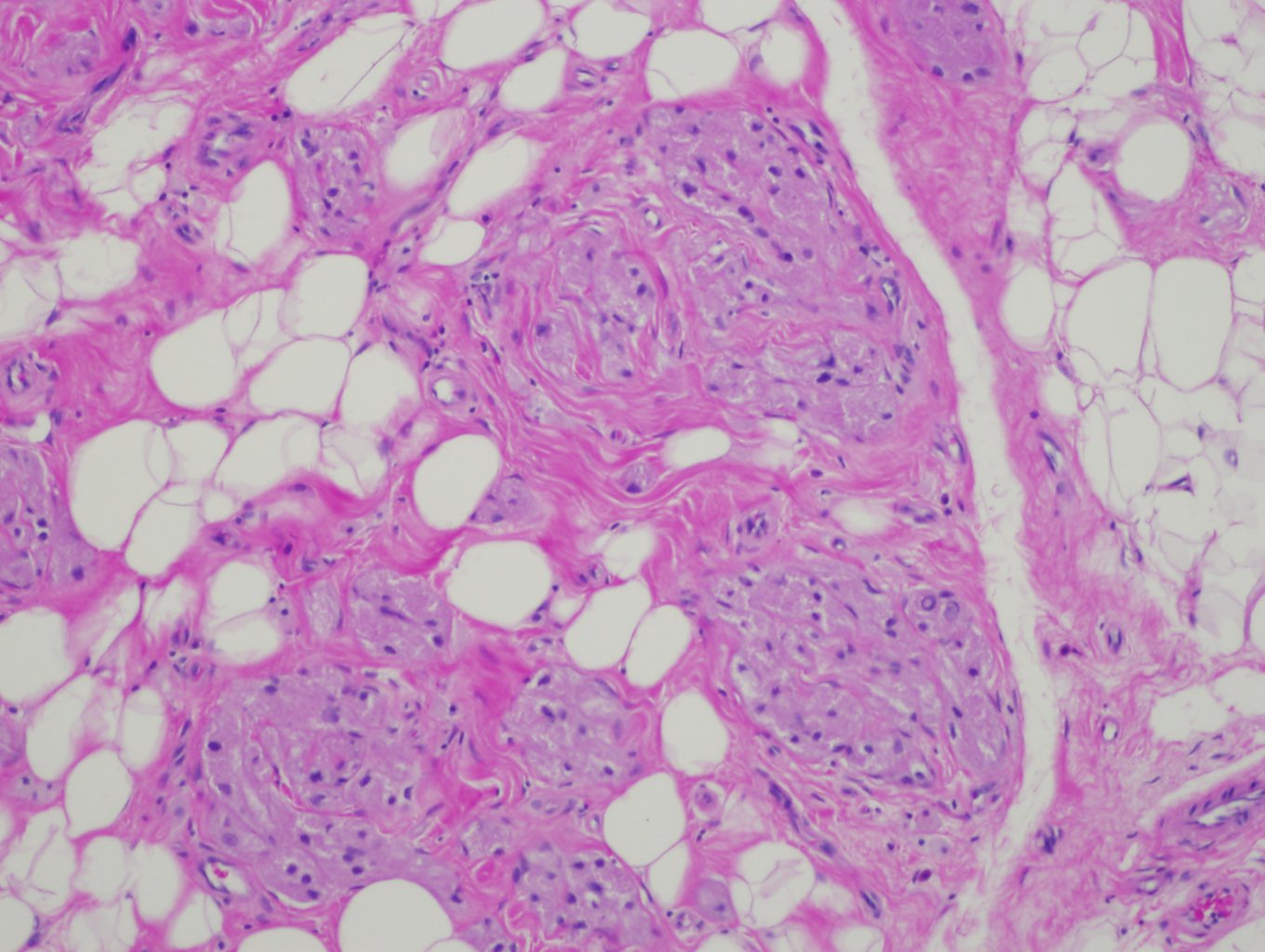 Granular Cell Tumor