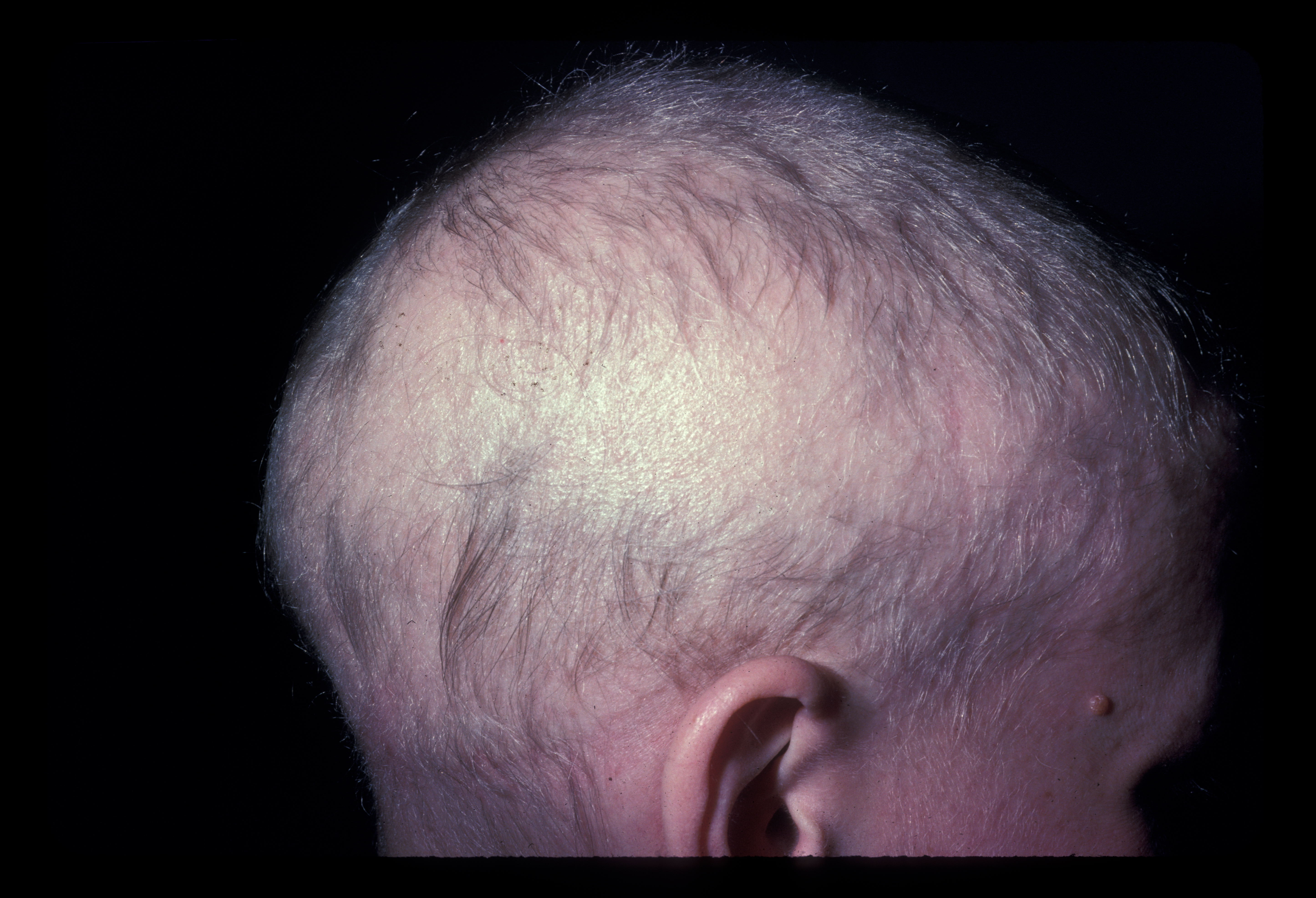 Alopecia totalis with some regrowth.